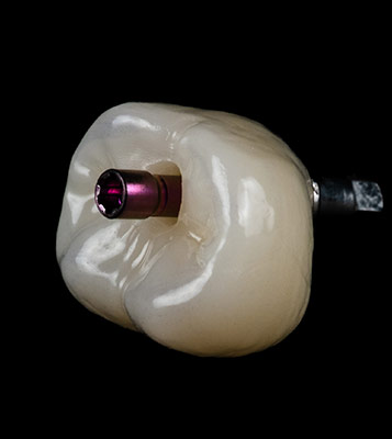 coronas-implantes