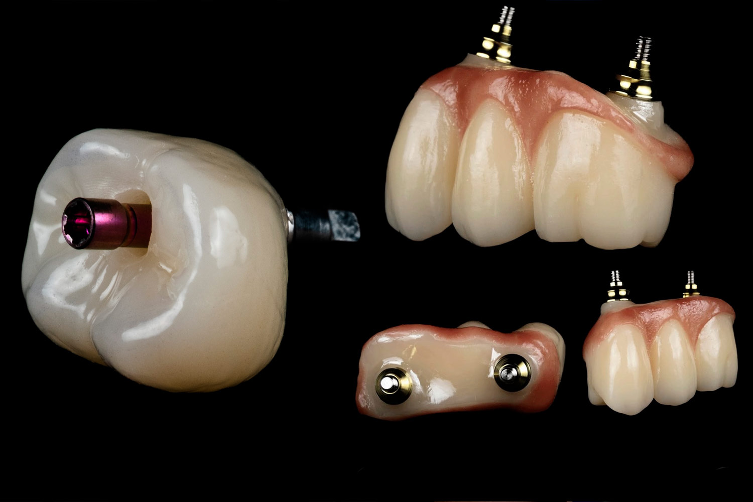 implantes